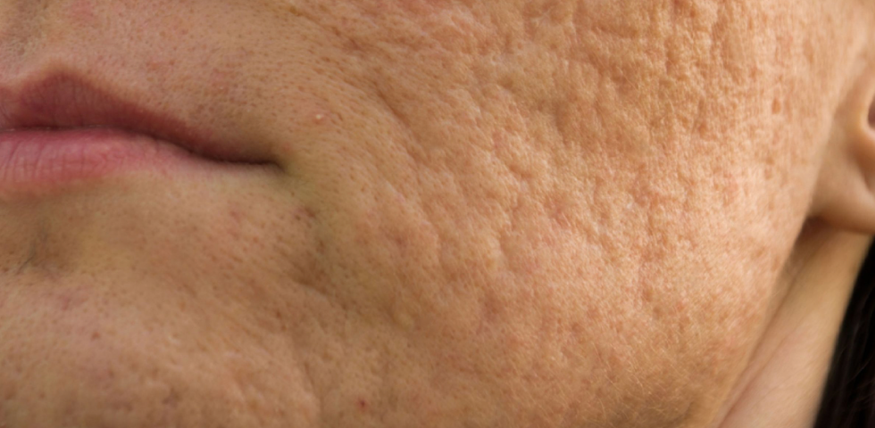 Acne-acne-scarring Skinstore